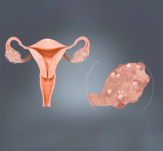 Troubles de l’ovulation